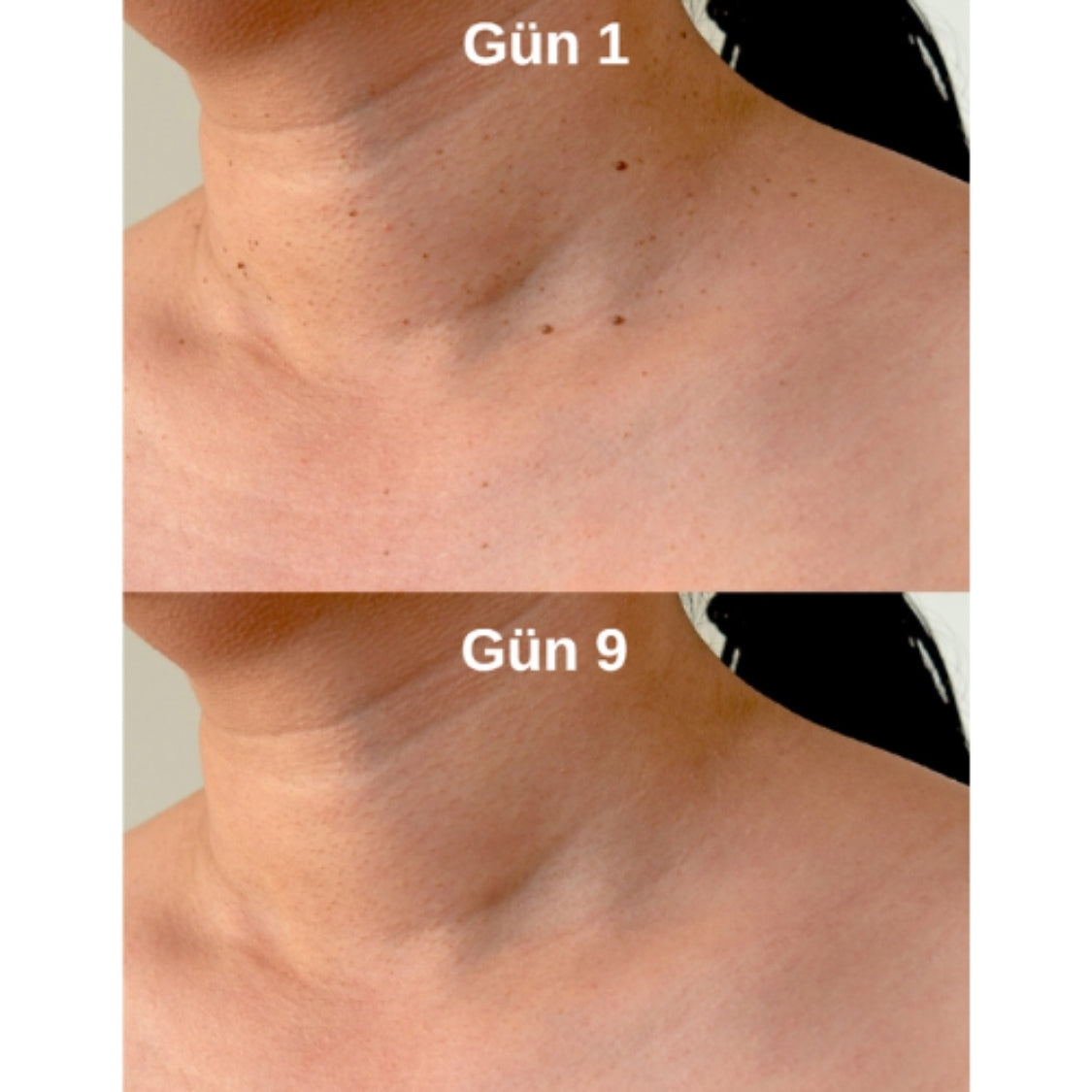 Novaten™ Et Beni ve Siğil Giderici Kit